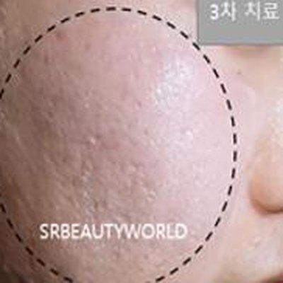 여드름 흉터 시술 후